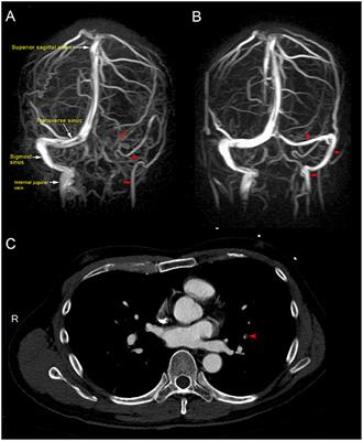 Cerebral Venous Sinus Thrombosis, Pulmonary Embolism, and Thrombocytopenia After COVID-19 Vaccination in a Taiwanese Man: A Case Report and Literature Review